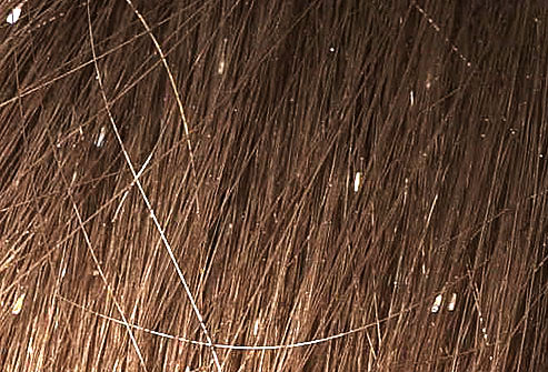 Nits are oval-shaped specks that you usually see near the scalp.